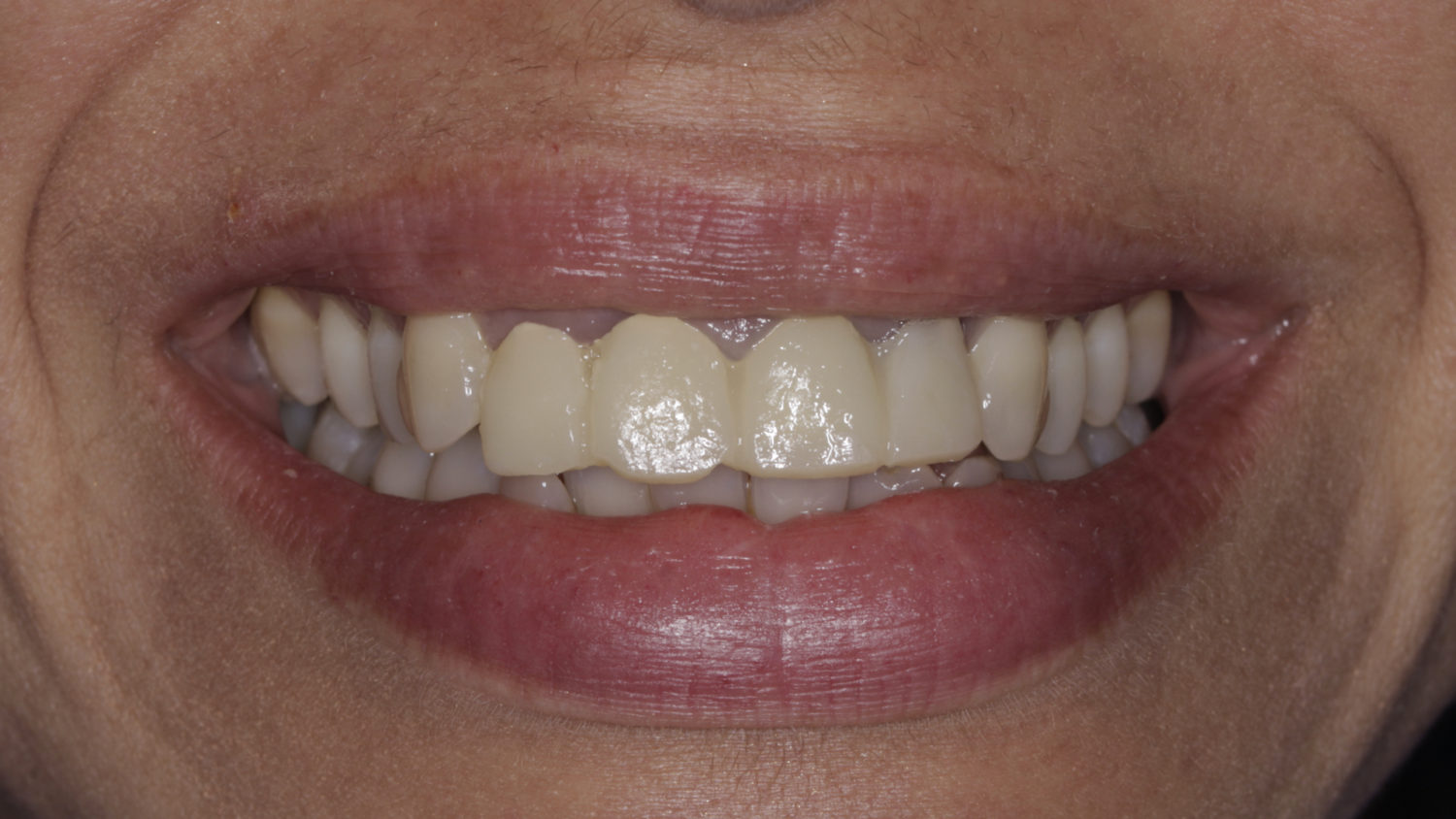 Vulkan Implants Clinical Case