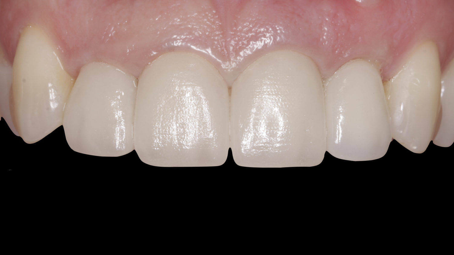 Vulkan Implants Clinical Case