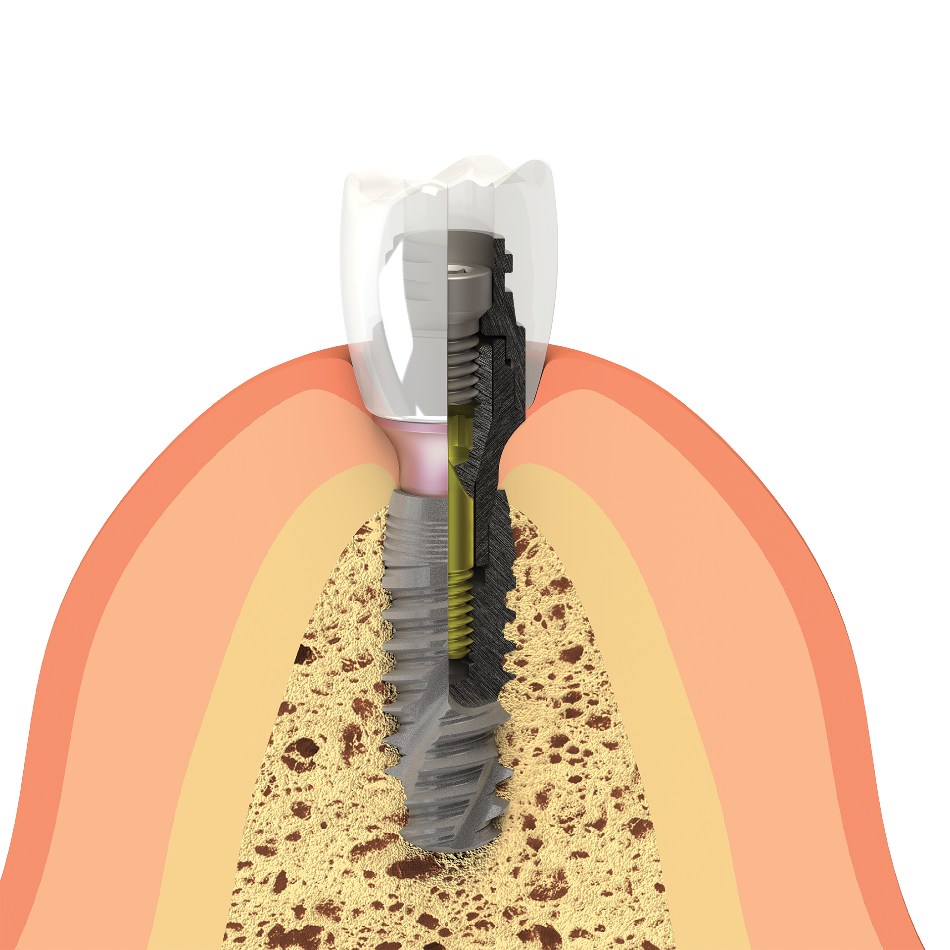 Tissue Care transepithelial abutment system to preserve connective tissue