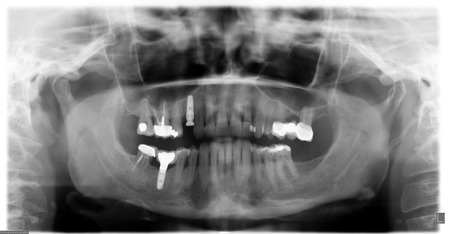 RX - Implante Cargado con Aditamento