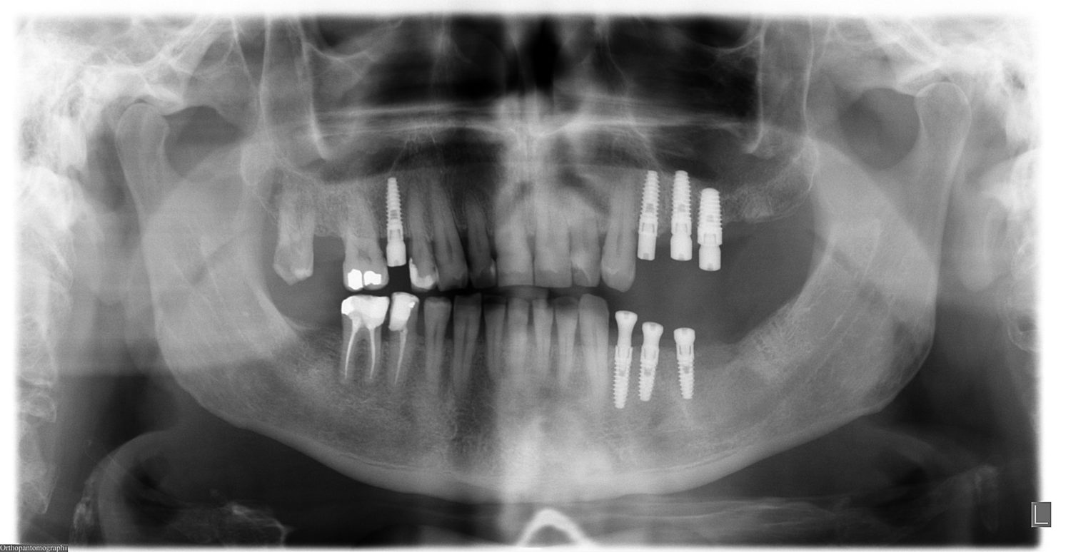 RX - Carga de Implantes y Aditamentos