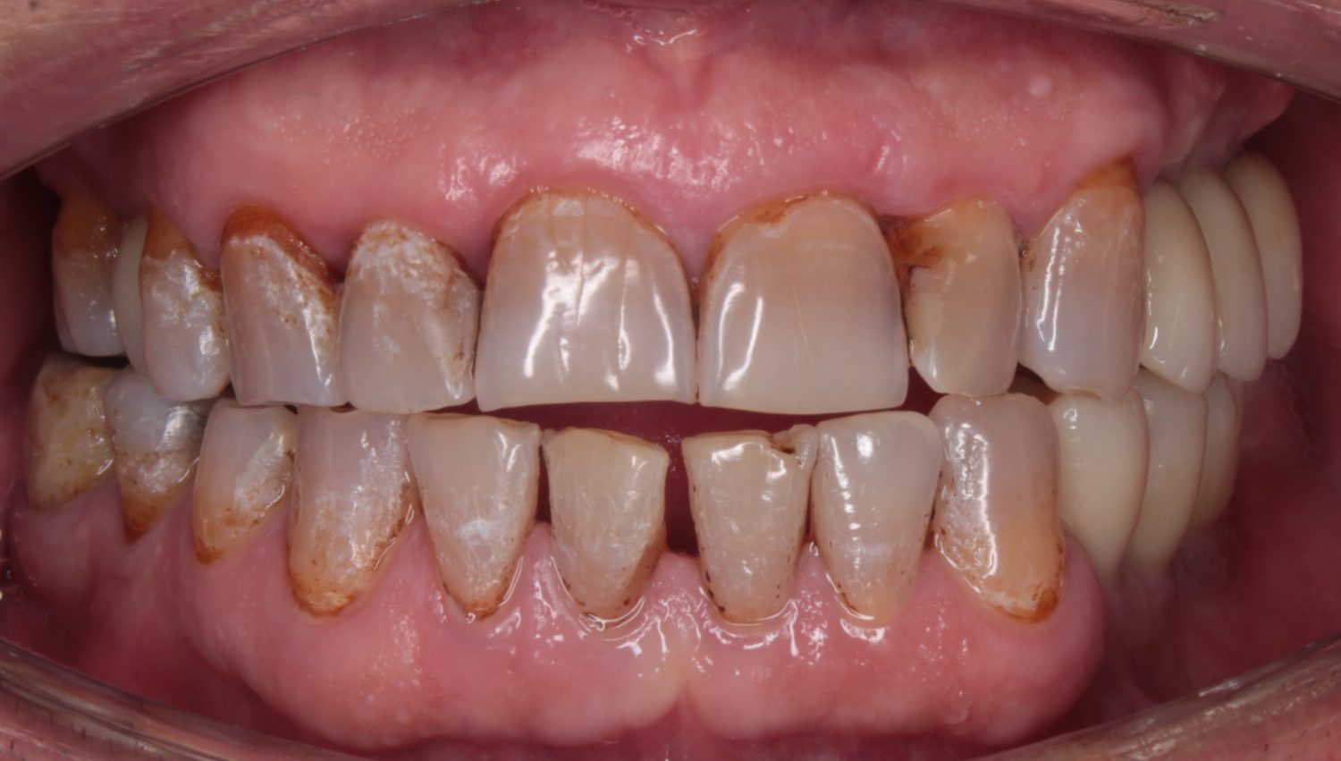Post-Operaci&oacute;n Resultado Final Sonrisa