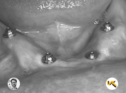 Portada Dr. Froilà Gisbert  Vulkan Conical Connection